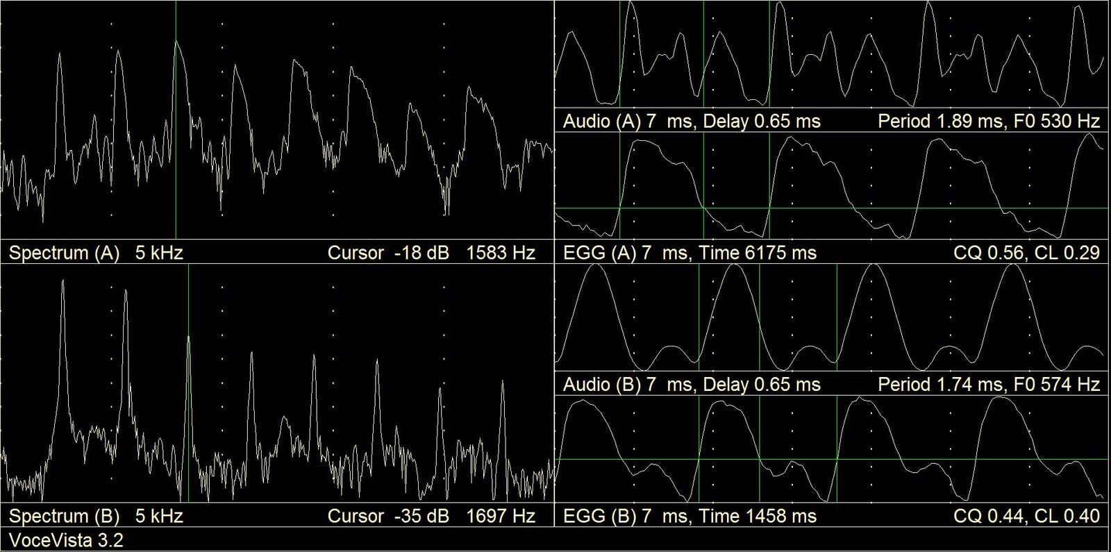 Comparison of EGG curve shape and level of the third harmonic between countertenor falsetto below and voce faringea above on C sharp 5